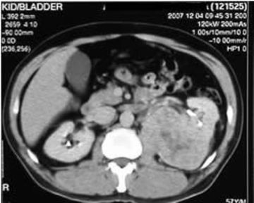 renal-mass-1c.jpg