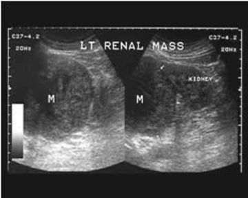 renal-mass-1j.jpg